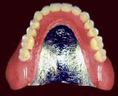 コバルトクロム床義歯 総入れ歯