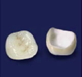 オールセラミック(e.max)臼歯部