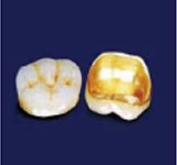 メタルボンドセラミッククラウン臼歯部