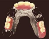 コバルトクロム床義歯 部分入れ歯