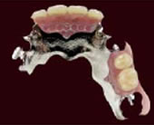 チタン床義歯 部分入れ歯