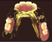チタン床義歯（ゴールドコーティング）部分入れ歯