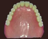 プラスチック義歯 総入れ歯