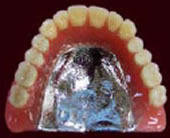 チタン床義歯 総入れ歯