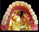 チタン床義歯（ゴールドコーティング）総入れ歯