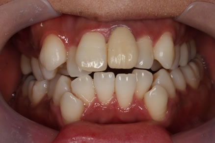 審美セラミック症例 前歯＋ホワイトニング